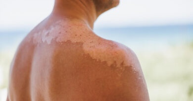 close-up-man-s-shoulder-with-sunburn-skin-sloughs-off-its-his-burn-skin-it-is-cause-melanoma