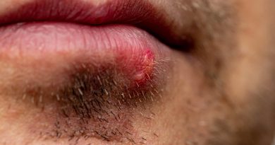 Herpes Lower Lip Male Unshaven Face