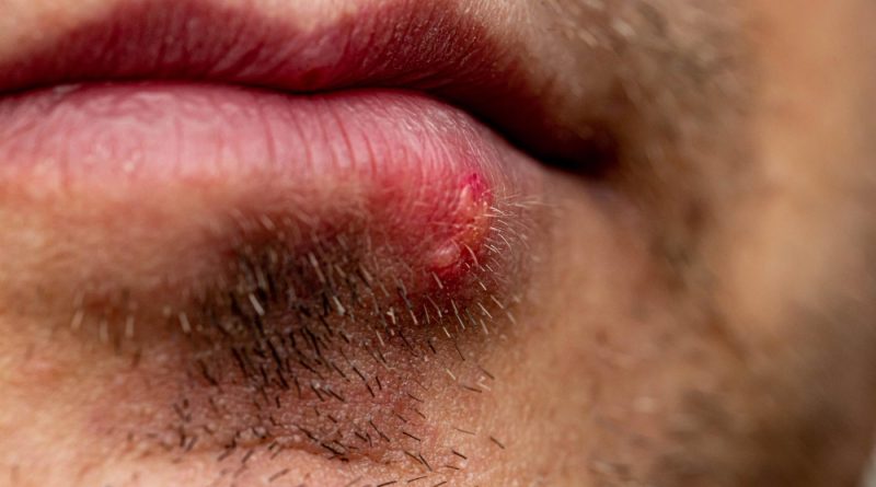 Herpes Lower Lip Male Unshaven Face